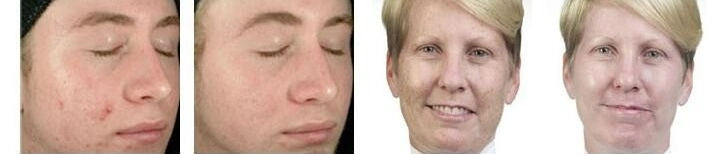 Dermabrasion Facial Machine H2O2 Aqua Peel Diamond Peeling and Hydrafaci 6 En 1 Facial Lift Skin Sccruber Moisturizer